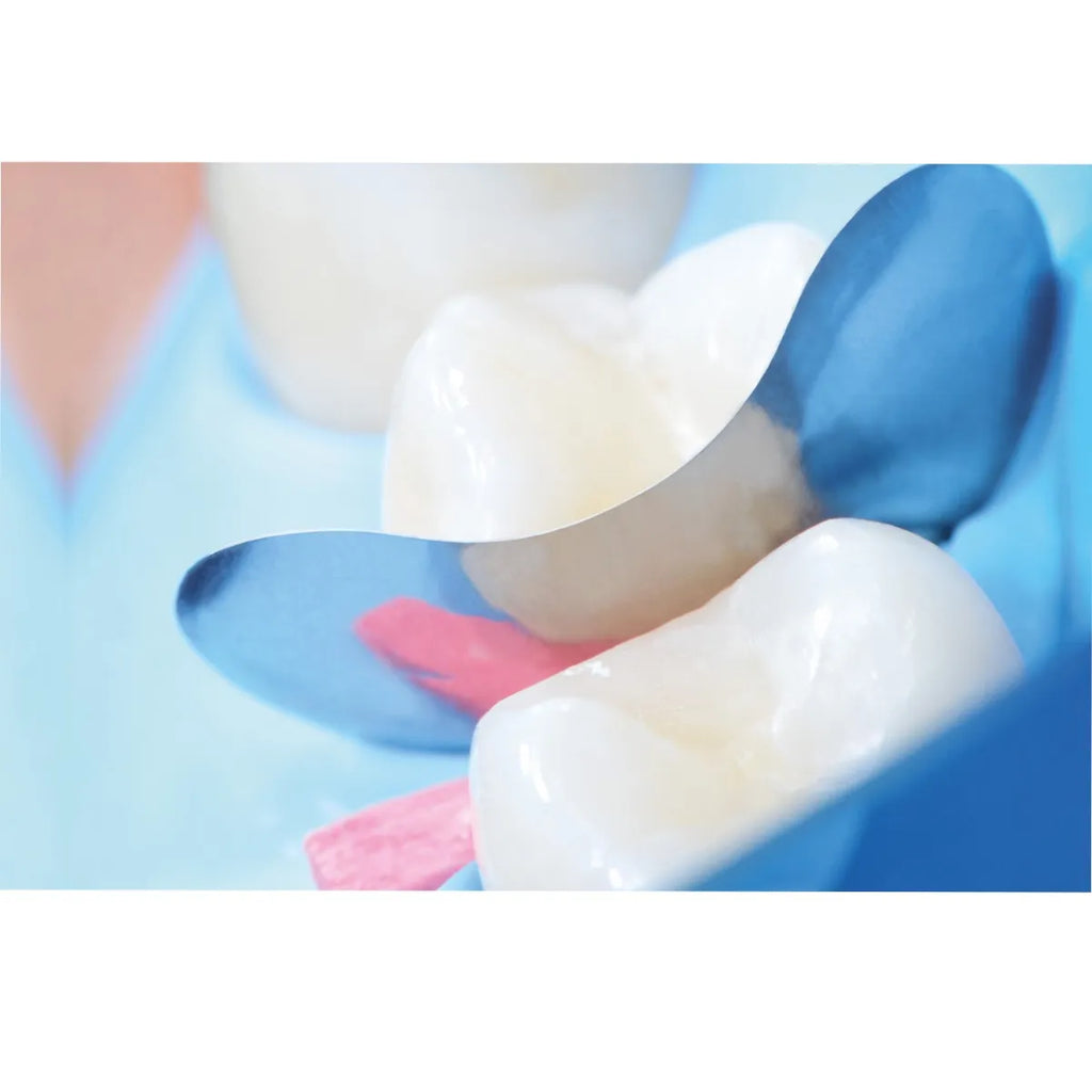 Close up of posterior teeth with blue matrix band and pink wedge placed for restoration QuickmatFLEX sectional matrices