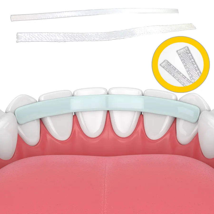 Beetle Dental kids dental splint clear flexible lingual bar for front teeth with adhesive reinforcement strips