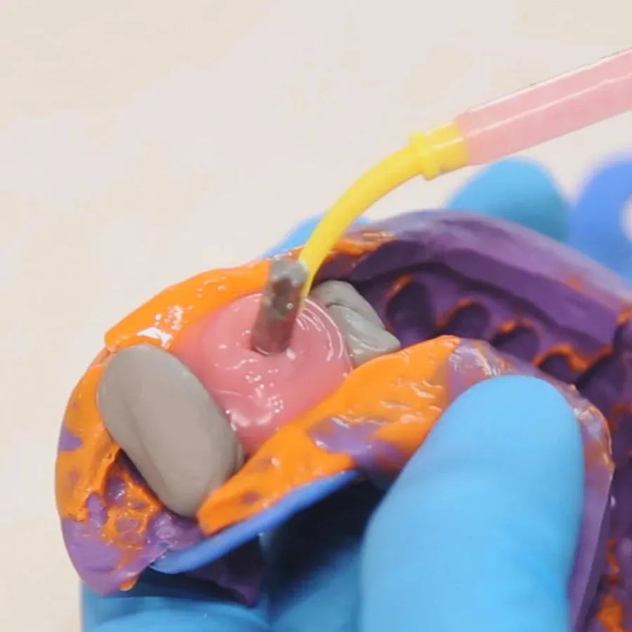 Beetle Dental A-silicone gingival mask being injected around implant on dental impression tray for tissue replication