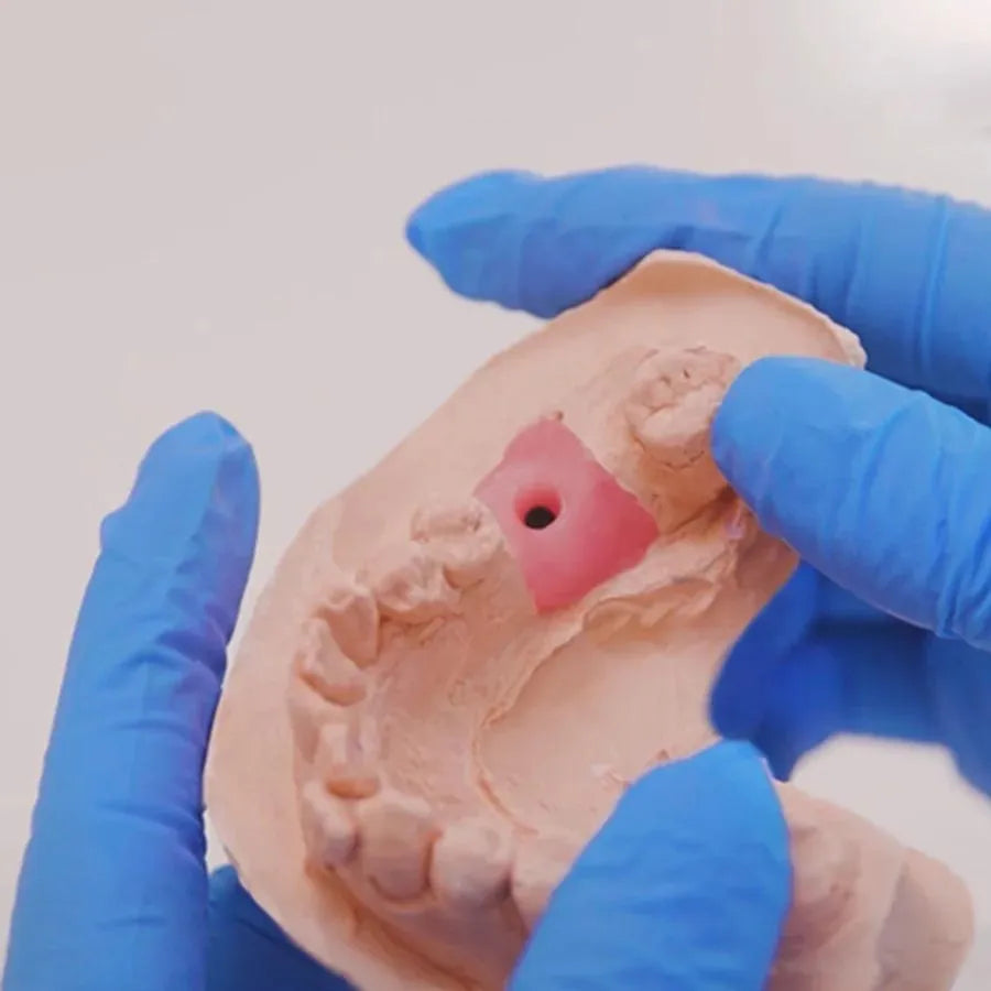 Dental technician wearing blue gloves holding a plaster model with A-silicone gingival mask. Implant site visible