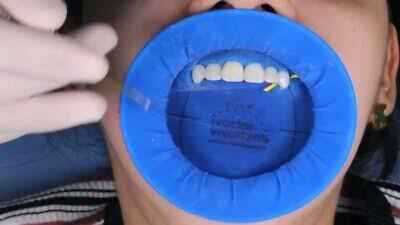 Beetle Dental OptraGate Refill - Eye Lid Retractor Set