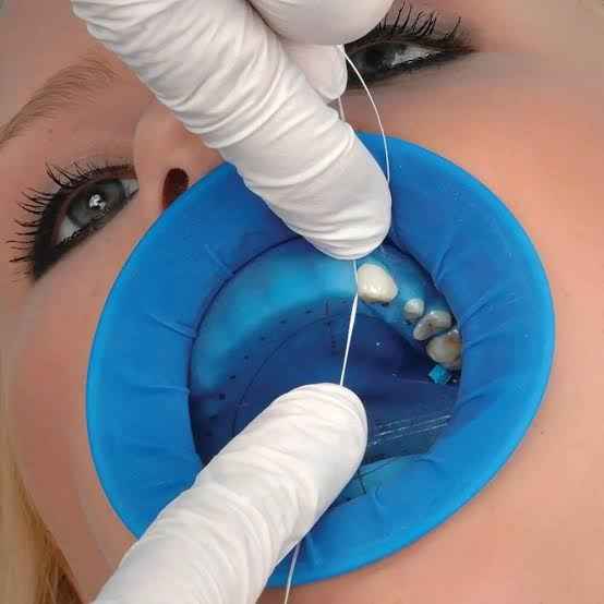Beetle Dental OptraGate Refill - Eye Lid Retractor Set