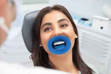 Beetle Dental OptraGate Refill - Eye Lid Retractor Set