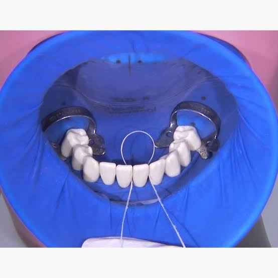 Beetle Dental OptraGate Refill - Eye Lid Retractor Set