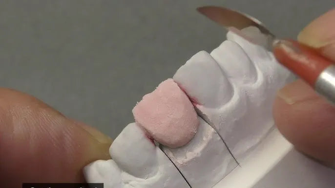Dental technician sculpting a pink crown on a plaster model using Noritake Super Porcelain EX-3 Opacious Body for accurate anatomy