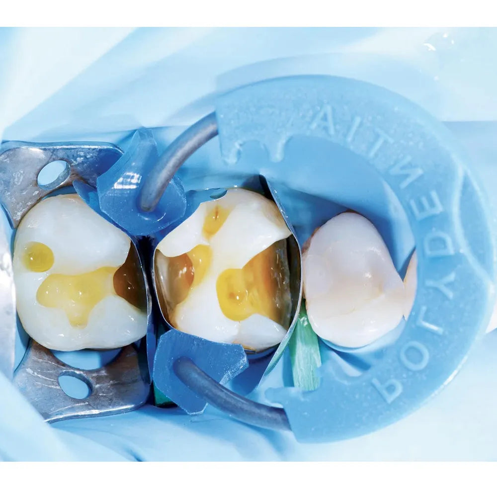 Polydentia Diamond24 Silicone Tubes dental rubber dam and clamps isolating two molars during restorative procedure