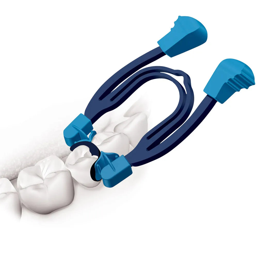 Polydentia MyClip 2.0 sectional matrix system blue clips and rings positioned on molar for interproximal restoration