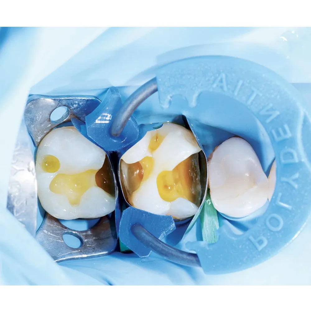 Polydentia MyQuickmat Classico sectional matrix kit used on posterior teeth with rubber dam and wedges