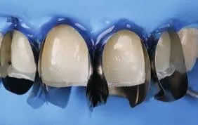 Anterior teeth isolated with blue rubber dam and stainless steel dental matrix strips placed for composite restorations