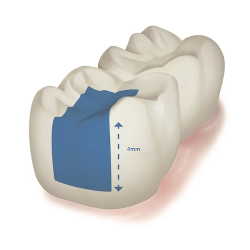 Illustration of a molar showing a 4mm posterior restoration with blue composite Prime Restorite bulk fill dental kit