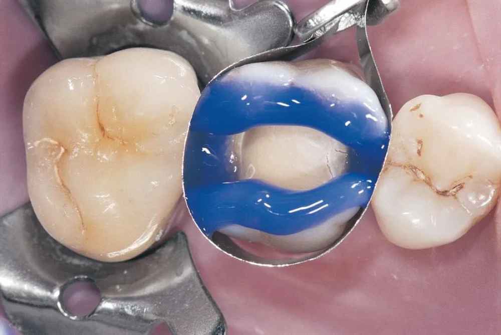 D Tech Etchant Gel