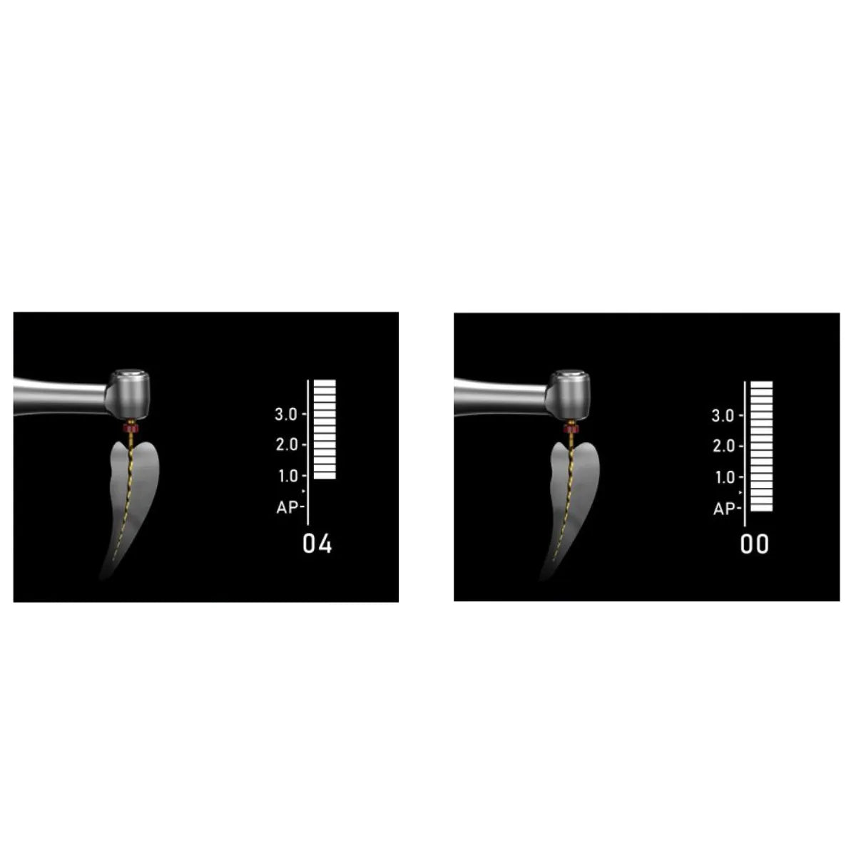 Woodpecker Endopace Pro Endomotor showing dual display apex locator simulation with endodontic file in root canal